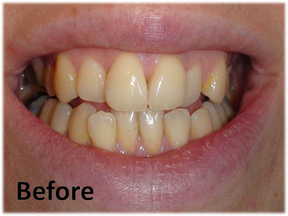 clara beauty teeth whitening review