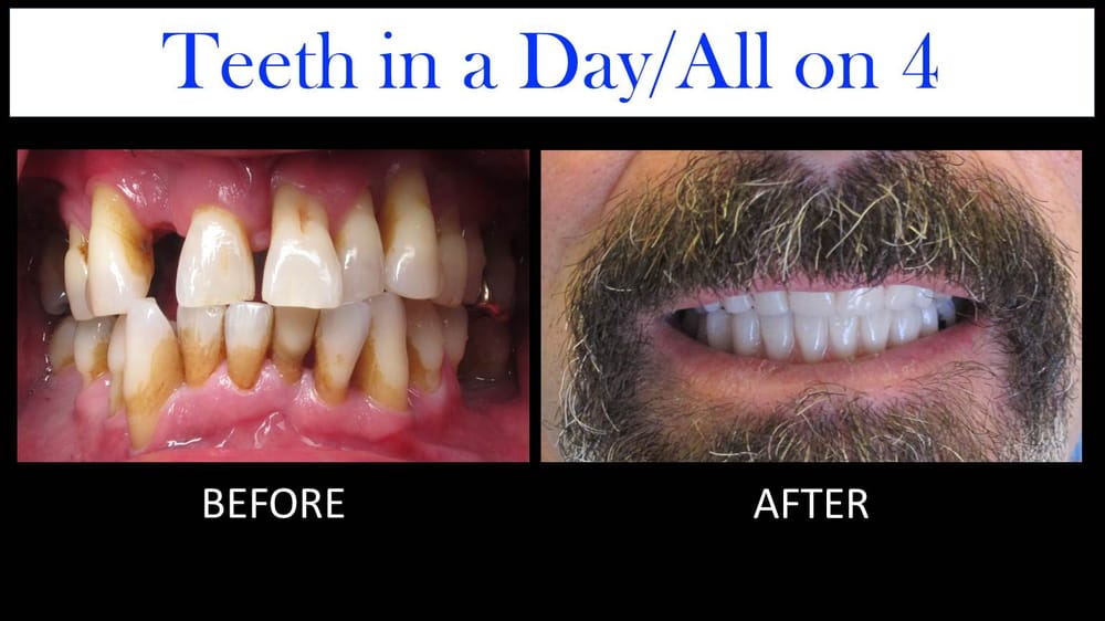 1 day dental implants reviews