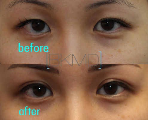 dr shen double eyelid review